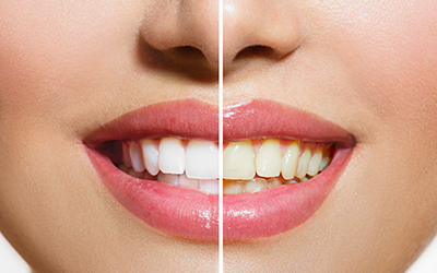 An up-close image of a smile with whitening