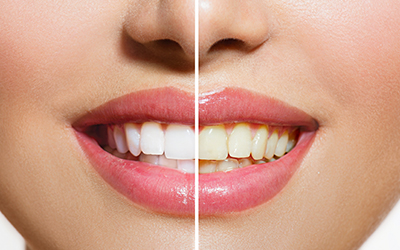 Teeth stains before and after