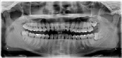 Impacted wisdom teeth X ray