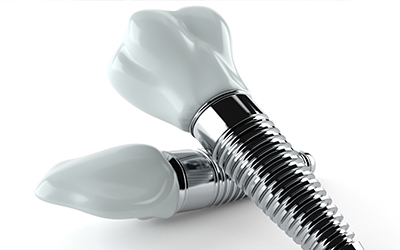 Dental Implants