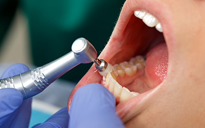 Professional Dental Brushing