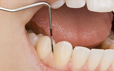 Dentist looking up-close at a patients gums