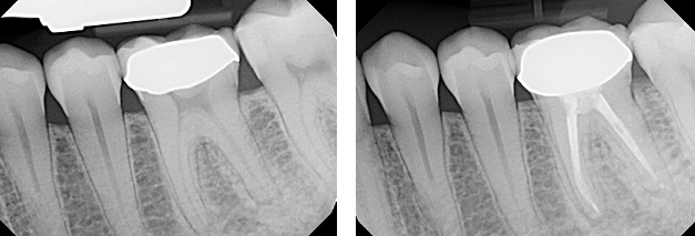 Root Canal X Ray