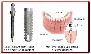 Mini Dental Implants