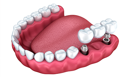 An image of a mouth and dental implants