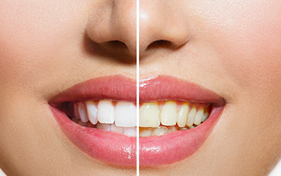 Teeth before and after whitening treatments