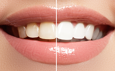 Perfect smile before and after whitening