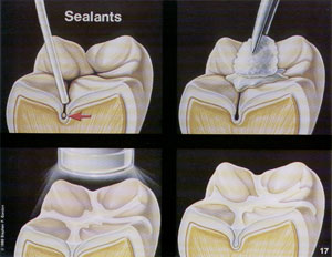 Dental Sealants