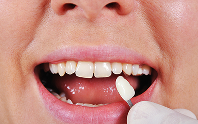 shade determination for teeth